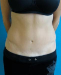 tummy_tuck_B_post_1